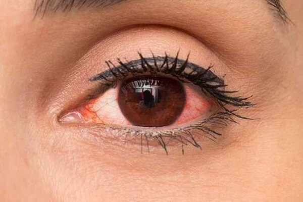 Không sử dụng kính áp tròng khi mắt có dấu hiệu viêm